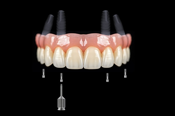 Reasons To Consider All On  ® Teeth Replacement