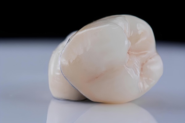 Dental Crowns: Common Issues And How To Address Them